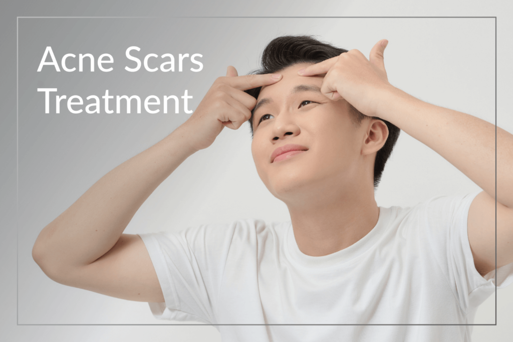 Acne scars treatment at BossBeautyBar