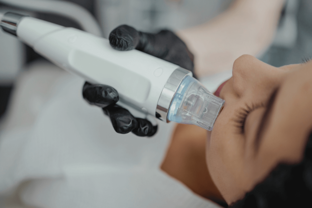 Microneedling treatment for acne scars at BossBeautyBar