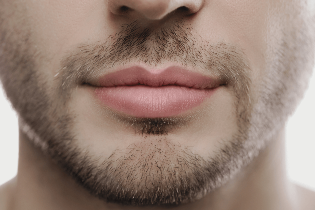 RF Microneedling treatment for acne scars at BossBeautyBar