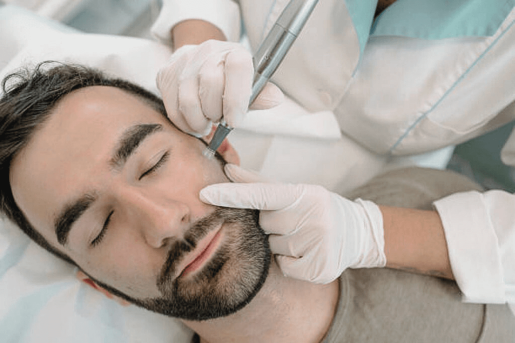 A male client receiving microneedling treatment at BossBeautyBar for skin rejuvenation.