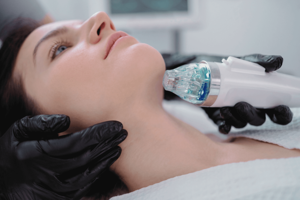 Woman receiving Microneedling + RF treatment at BossBeautyBar for skin tightening and rejuvenation.