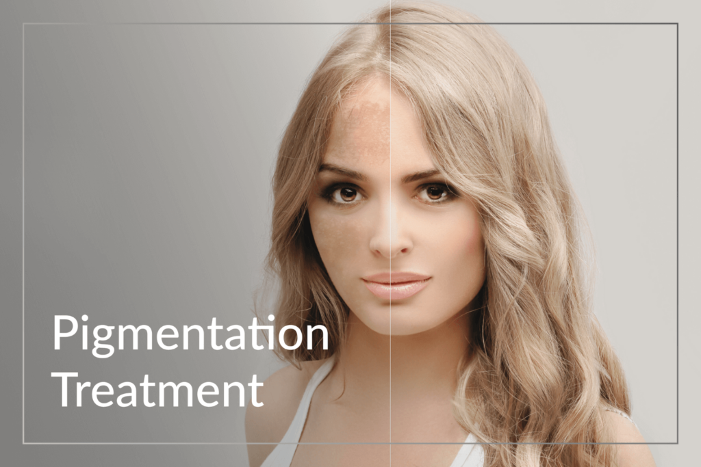 Pigmentation Treatment at BossBeautyBar showcasing skin transformation.