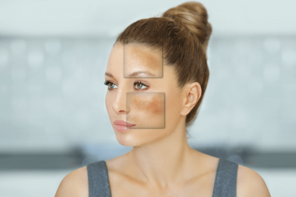 Woman with melasma showing visible skin pigmentation patches.