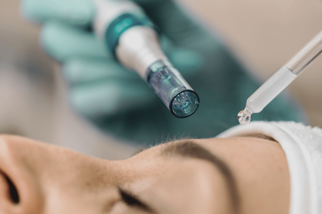 Professional performing microneedling with exosomes at BossBeautyBar for advanced skin rejuvenation.